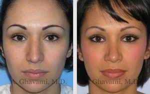 Rhinoplasty Patient Before & After Photos