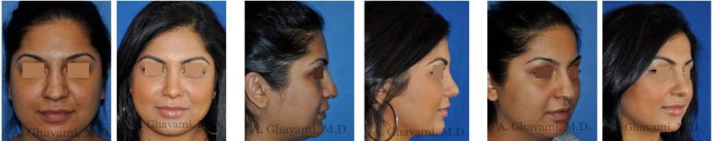 Patient Example 3: Reshaping & Bridge Narrowing