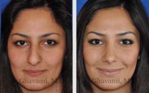 Rhinoplasty Patient Photos