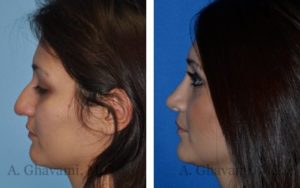 Rhinoplasty Patient Before & After Photos