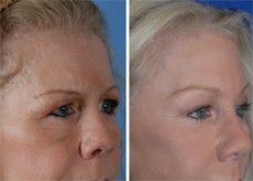 Brow Lift Patient Before and After in Beverly Hills