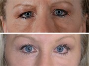 Blepharoplasty Patient Before and After in Beverly Hills