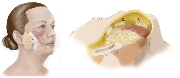 SMAS Facelift Technique of Dr. Ashkan Ghavami Beverly Hills