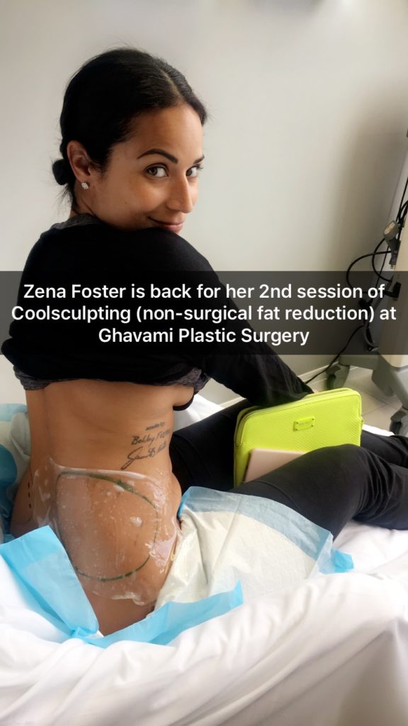 Zena Foster CoolSculpting Results