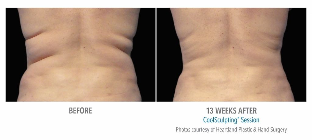 CoolSculpting Before and 13 Weeks Later