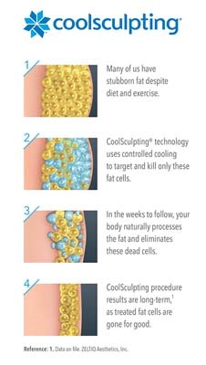 How CoolSculpting Works Infographic