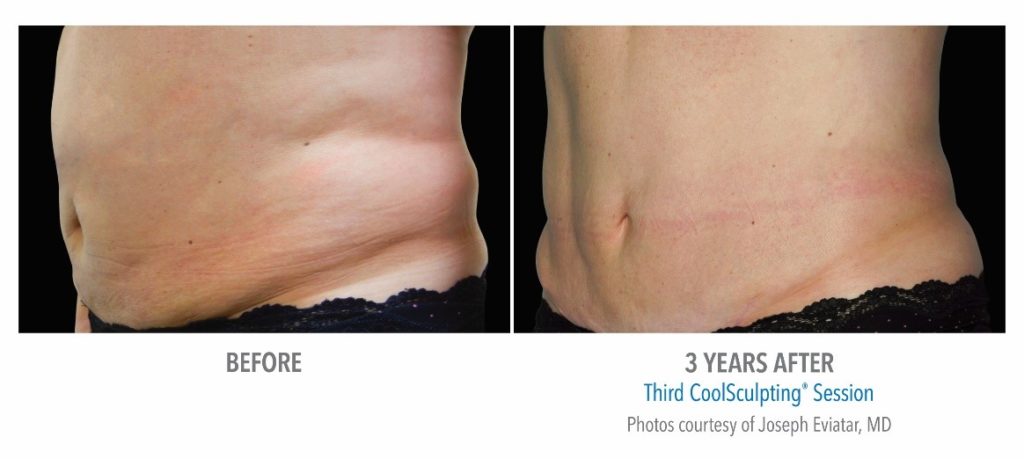 CoolSculpting Before After Results