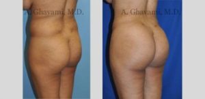 🥇 Buttock Augmentation - Los Angeles Plastic Surgery