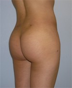 Buttock Patient After Augmentation in Beverly Hills