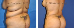 Patient Before & After Photos of S-Curve Surgery