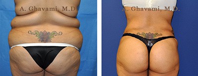 Butt Augmentation Before and After Photos