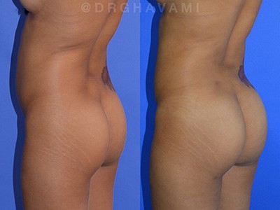 Results of Buttock Augmentation