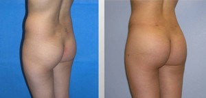 Butt Augmentation Patient Photos