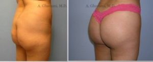 Before and After Photos of Butt Augmentation