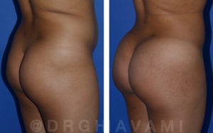 Butt augmentation patient in Beverly Hills