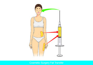 Fat Transfer in Beverly Hills