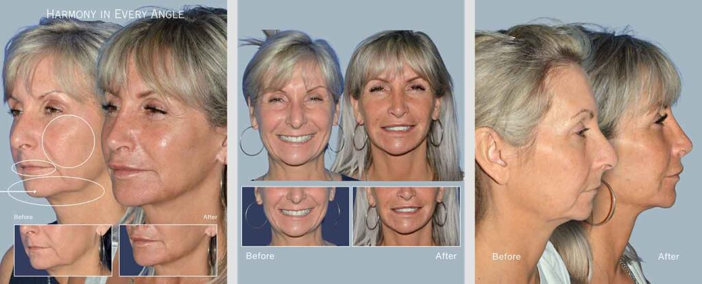 Facelift Before After Patient Images in Beverly Hills