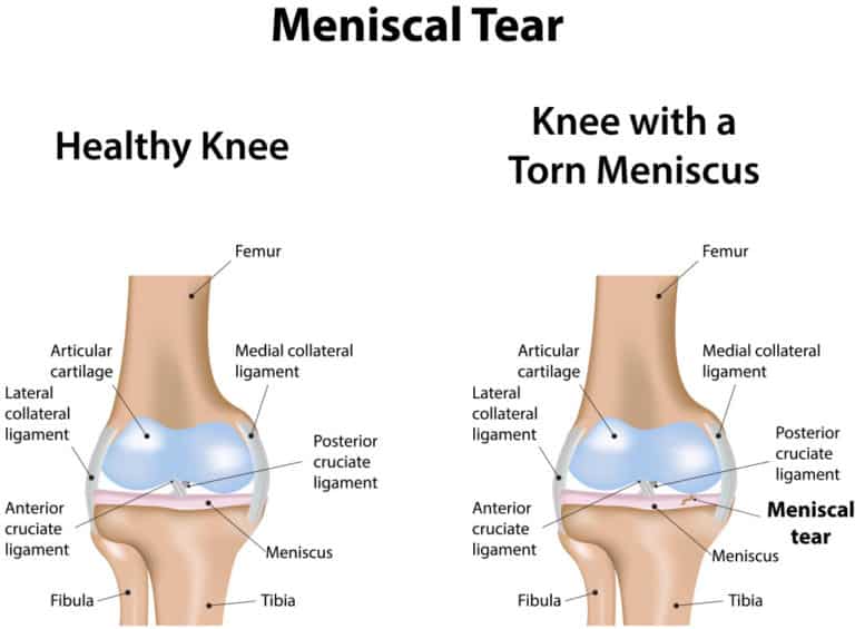 Meniscus Tear Burr Ridge, Plainfield & Morris, IL