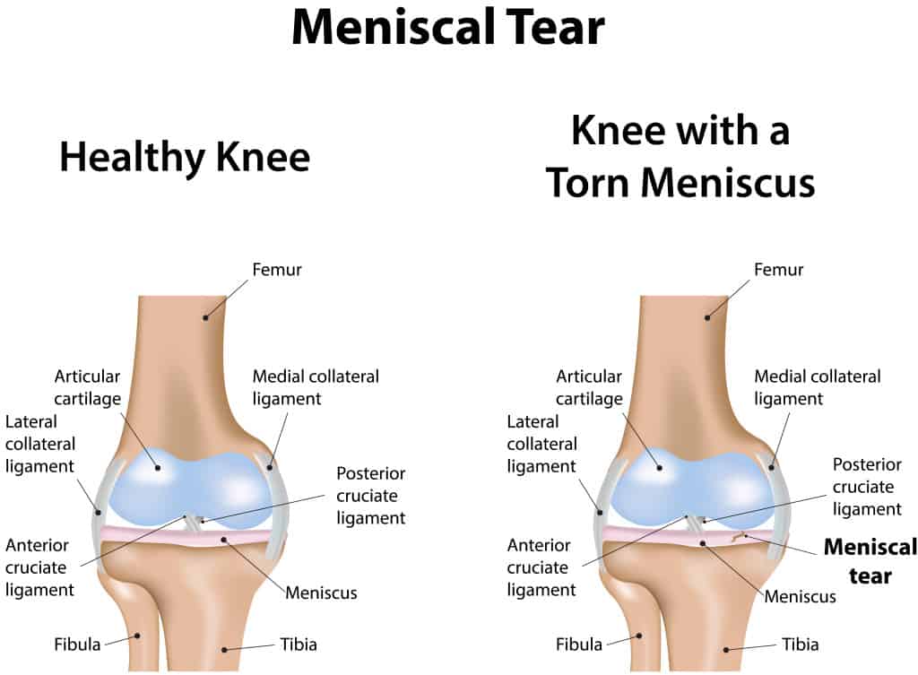 Meniscus Tear Symptoms Burr Ridge