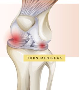 Meniscal Repair in Burr Ridge