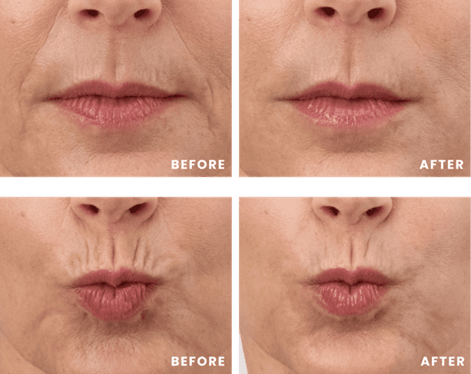 RHA Redensity™ for lip lines