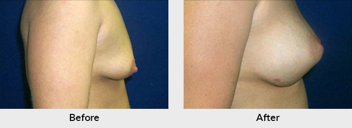 Breast Lift Before After Photo in Charlotte, NC