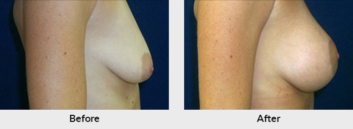 Mastopexy in Charlotte, NC