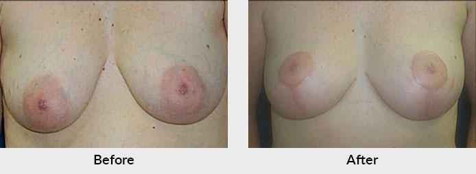 Breast Lift in Charlotte, NC