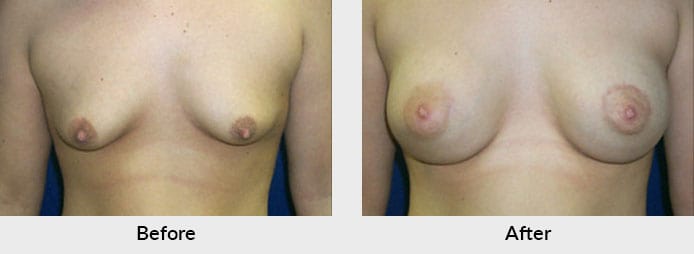 Breast Lift Patient in Charlotte, NC
