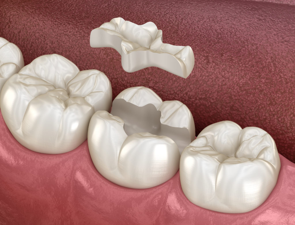 Dental Inlay and Onlay Placement