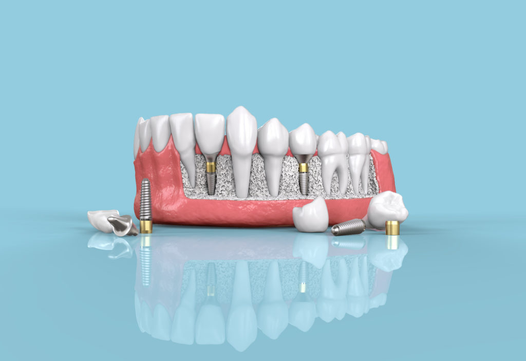 Models for Dental Implant Page