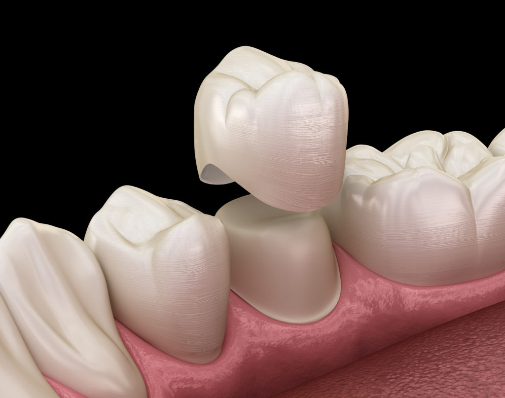 Dental Crown Placement for Patient