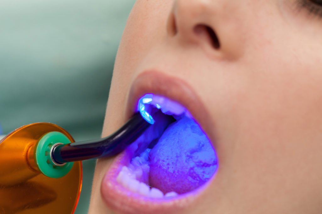 Dentist working out Dental Adhesive for Bonding