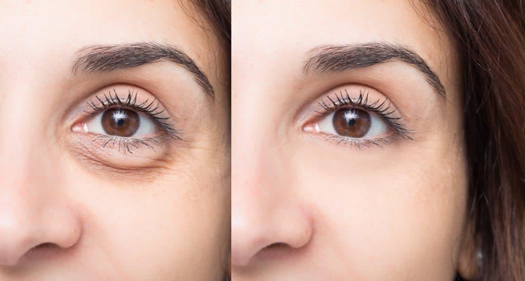 Eyelid surgery in Sacramento