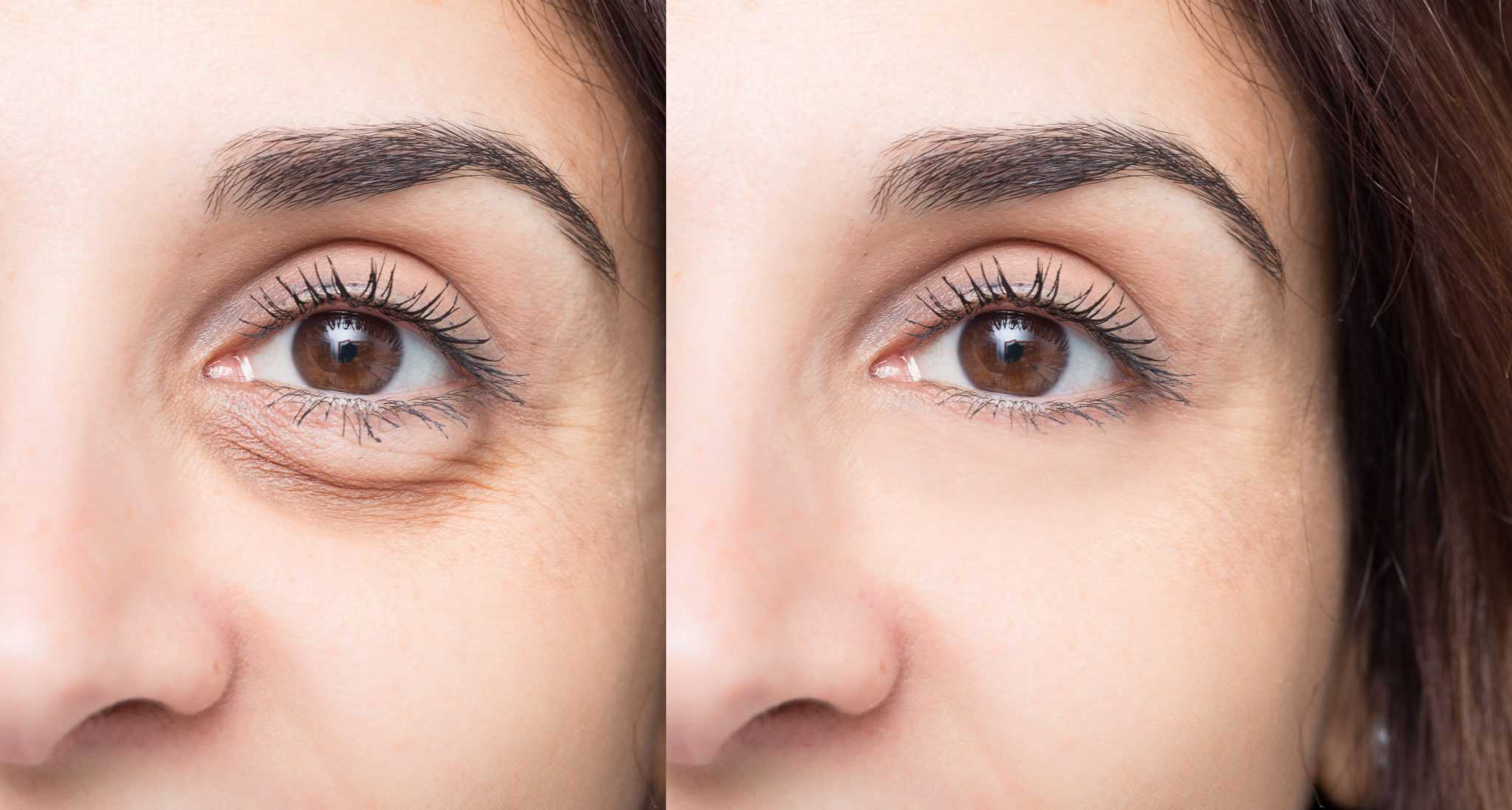 Festoon & Puffy Eye Treatments Sacramento Dr. Donald Hause