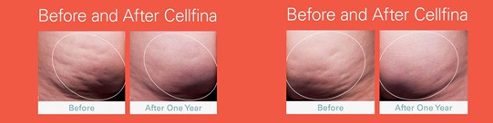 Before & After cellulite treatment Sacramento