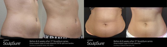 SculpSure body contouring Sacramento