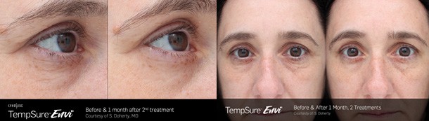 Sacramento TempSure wrinkle & fine line treatment