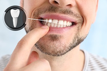 Dental Implat Procedure Houston, TX