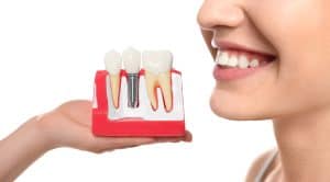 Dental Implants In Houston, TX