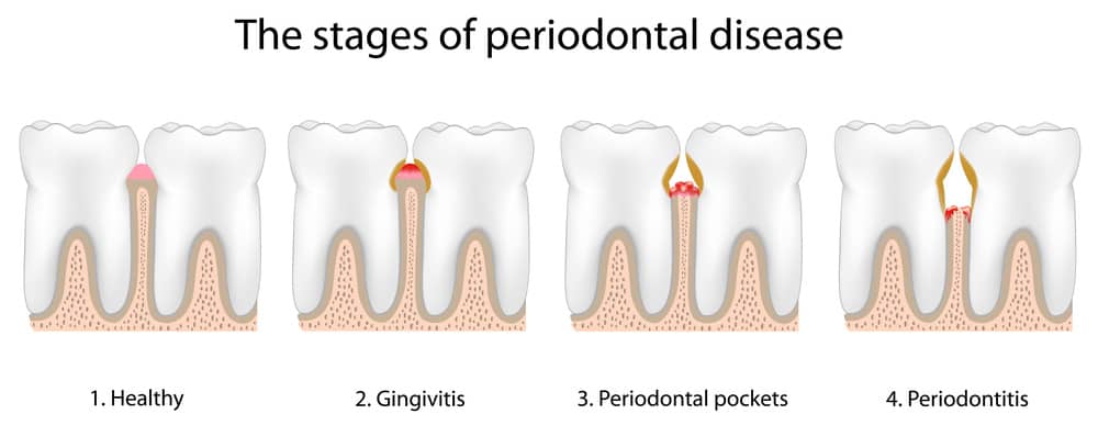 Illustration of the stages of periodontal disease