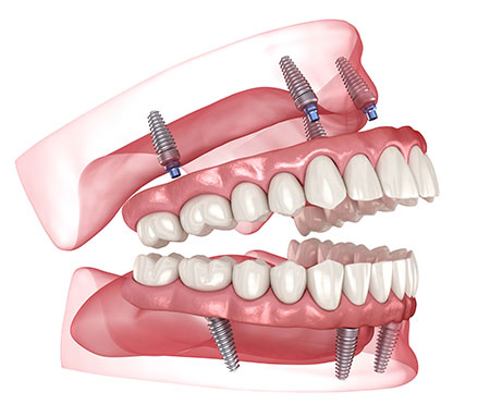 Albuquerque All-on-4 Dental Implants