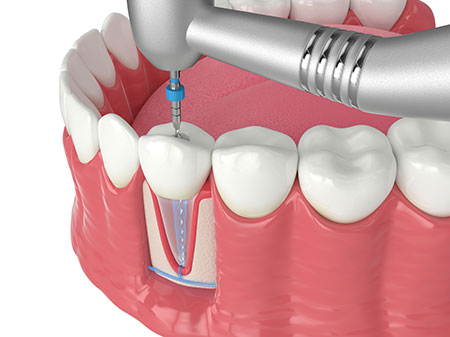 Endodontics In Albuquerque , NM