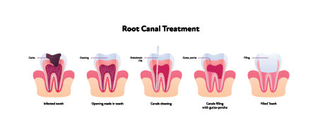 Root Canal Treatment In Albuquerque, NM