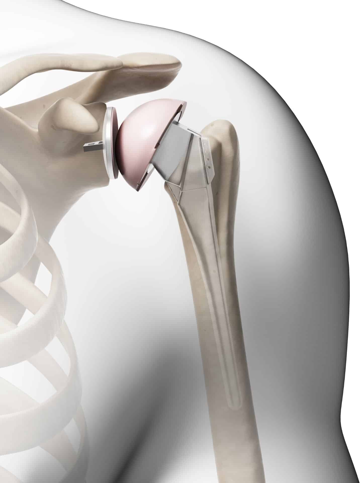 New Shoulder Replacement Joint