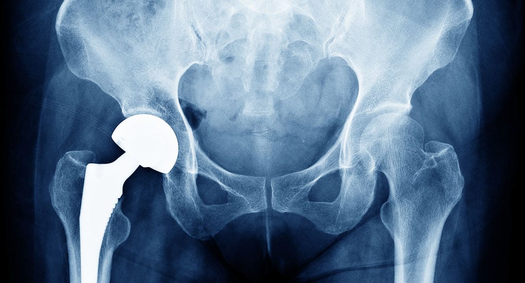 Hip Treatment in Dearborn and Jackson, MI