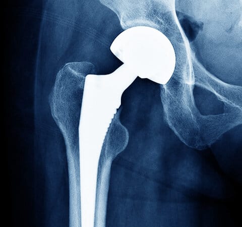 Joint Replacement in Jackson and Dearborn, Michigan