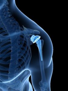 Joint Replacement in Dearborn and Jackson, Michigan