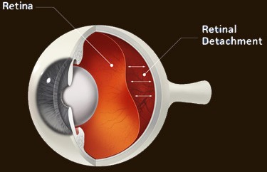 Floaters and Flashes Morristown | Morristown Ophthalmology Associates