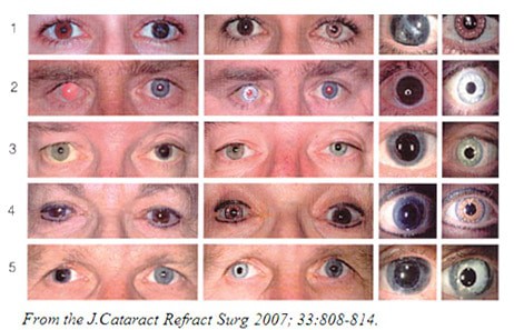 Iris Implants for Cataract Surgery Patients